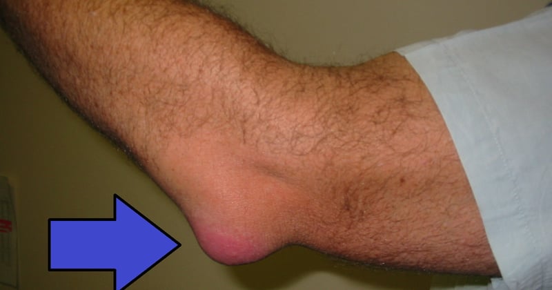 Bursitis trochanterica: Schmerzen an der Hüfte endlich loswerden
